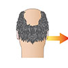 basics of hair transplantation