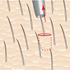 extracting hair grafts for transplantation