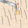 removing follicular units during hair transplant