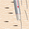 channels for donor follicular units grafts