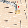 planting donor grafts