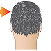 recovery after hair transplant